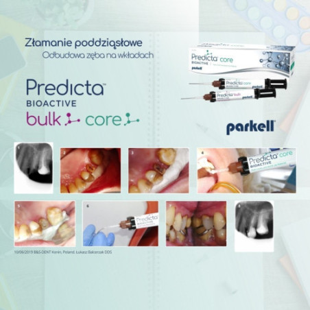 PREDICTA CORE Bioactive (Parkell) - bioaktywny materiał do odbudowy rdzenia zęba