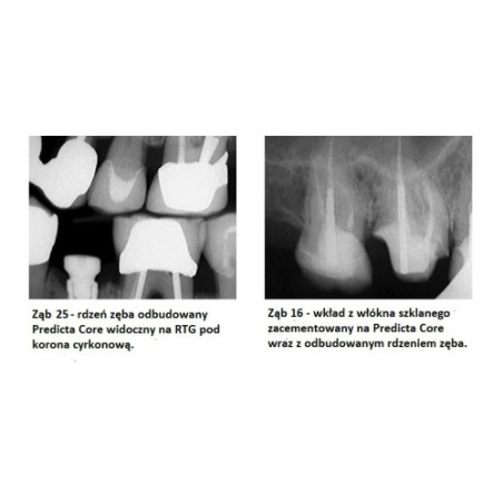 PREDICTA CORE Bioactive (Parkell) - bioaktywny materiał do odbudowy rdzenia zęba