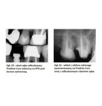 PREDICTA CORE Bioactive (Parkell) - bioaktywny materiał do odbudowy rdzenia zęba