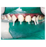 Core-Flo DC - odbudowa zrębu zęba