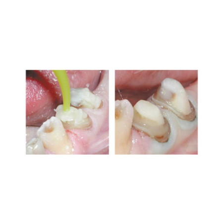 Parkell USA Absolute Dentin - odbudowa rdzenia zęba w kolorze zębiny 50ml