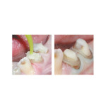 Parkell USA Absolute Dentin - odbudowa rdzenia zęba w kolorze zębiny 20ml/50ml