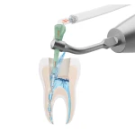 Pac-Dent iVac System do irygacji Intro Kit