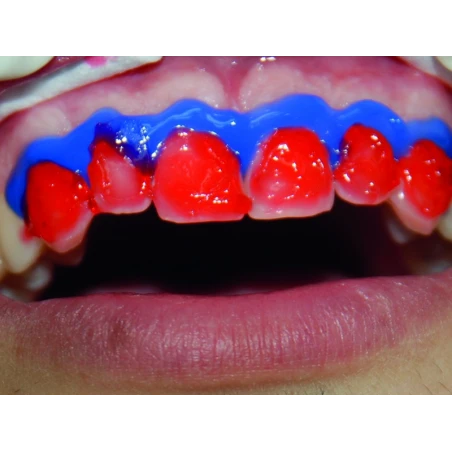 Notredam - Płynny Koferdam 2 x 5 g strzykawka