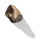 BIOMED 3D Tooth - Ząb Treningowy - Centralny siekacz 1,4 mm otwarty wierzchołek